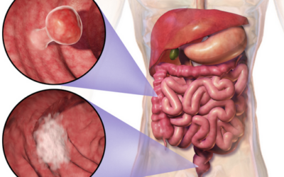 Un clade di Fusobacterium nucleatum domina il cancro del colon-retto