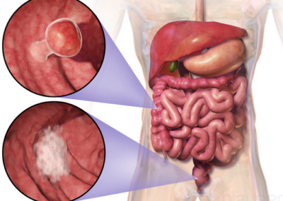 Un clade di Fusobacterium nucleatum domina il cancro del colon-retto