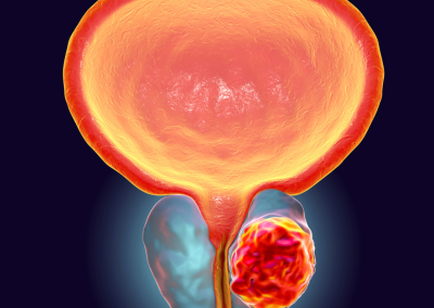 Ruolo degli Acidi Grassi nel controllo del Cancro della Prostata