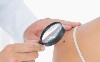 Melanoma in età pediatrica: Efficacia e attività degli anticorpi anti PD-1