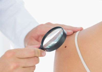 Melanoma in età pediatrica: Efficacia e attività degli anticorpi anti PD-1