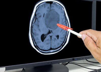 Vantaggi dell’impiego di Gabapentinoidi nel glioblastoma