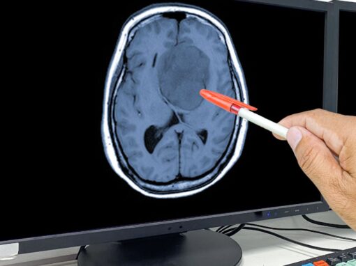 Vantaggi dell’impiego di Gabapentinoidi nel glioblastoma