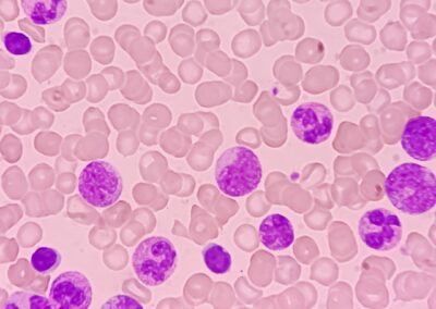 Medical Imaging and Pediatric and Adolescent Hematologic Cancer Risk