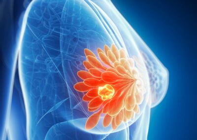 Comprehensive analysis of the systemic immune landscape across breast cancer subtypes and disease stages